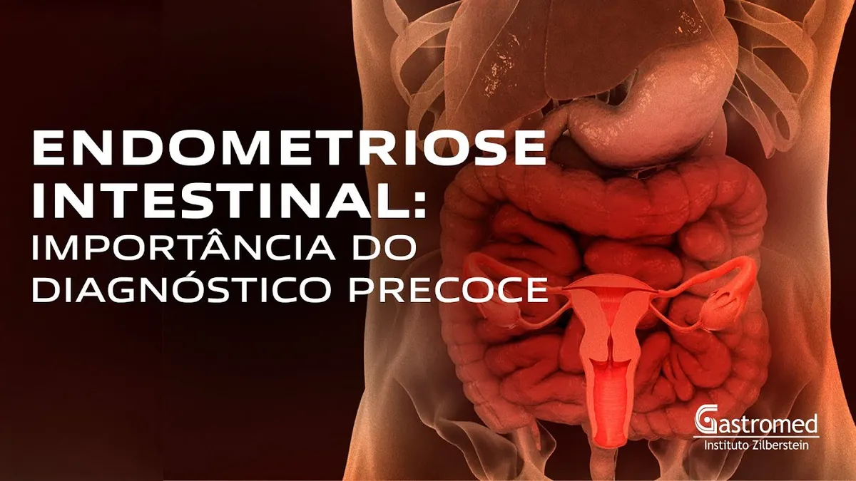 Endometriose Intestinal: 7 Sintomas, Diagnóstico Precoce e Tratamento