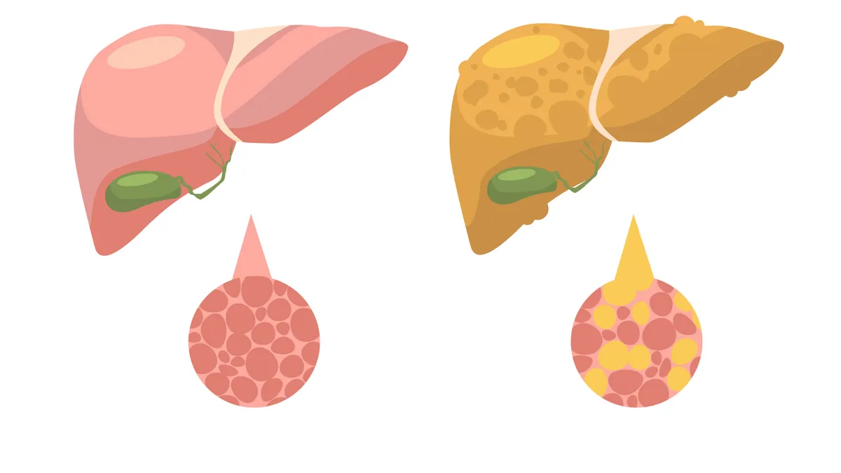 Esteatose Hepática (Fígado Gorduroso): Causas, Graus da Doença e Formas de Tratamento