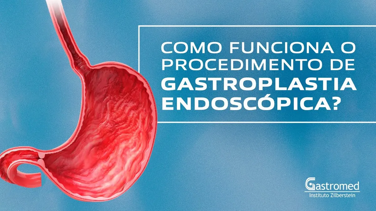 Gastroplastia Endoscópica: Como Funciona, 5 Indicações e Resultados