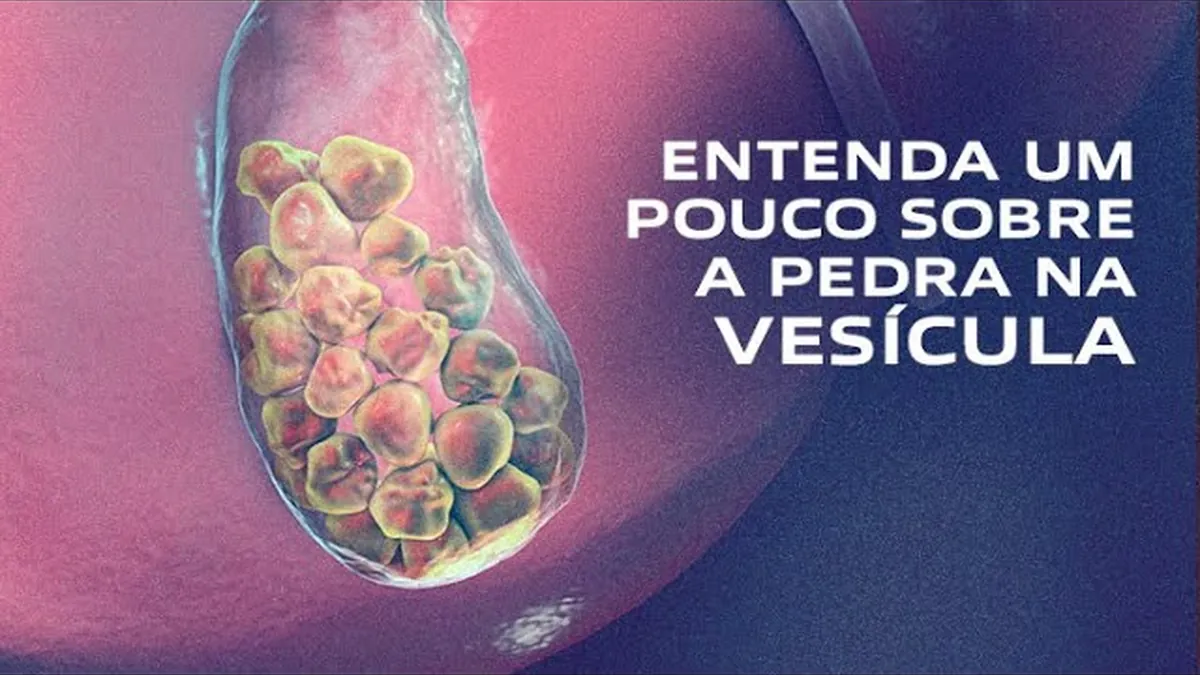 Pedra na Vesícula (Colelitíase): 8 Fatores de Risco, Sintomas e Tratamento
