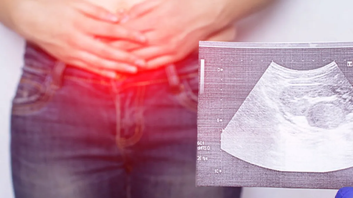 Recebeu o diagnóstico de hérnia inguinal? Entenda como funciona o tratamento