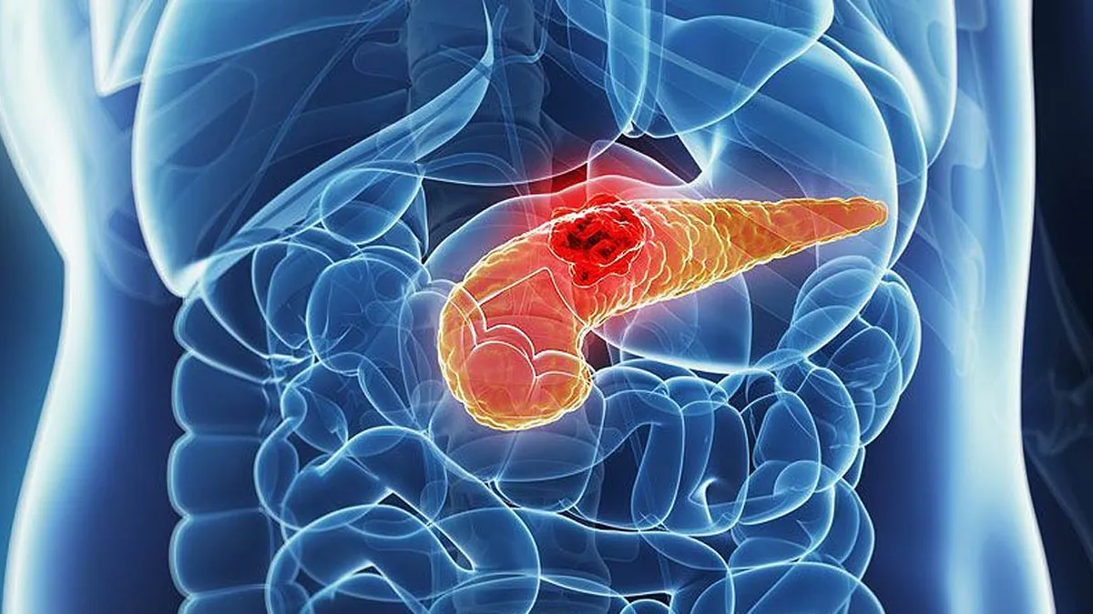 Tratamento Clínico e Cirúrgico da Pancreatite